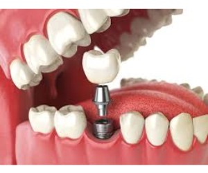 Dental Implants: The Good, the Bad and the NOT so Ugly