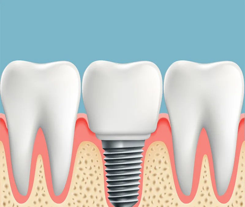 All About “All-­On‐Four” Dental Implants: Learn about the Procedure, Recovery, Costs and Possible Complications