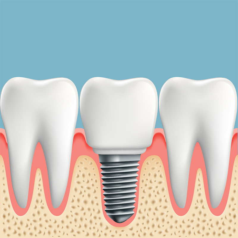 All About “All-­On‐Four” Dental Implants: Learn about the Procedure, Recovery, Costs and Possible Complications