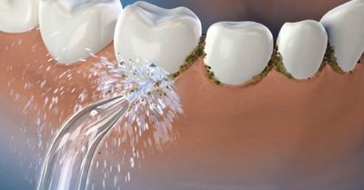 What’s Better for Your Teeth? Waterpik vs. Flossing