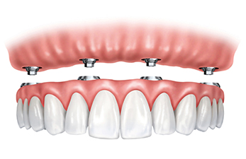 Dental Implants: All-on-4, All-on-6, All-on-8